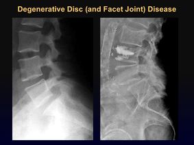 degenerative disc injury chiropractors balaclava VIC